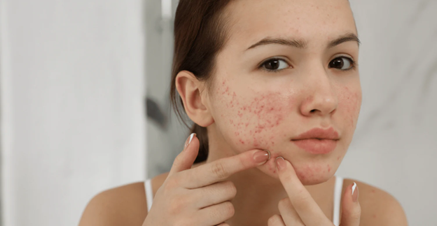 Blemish-Prone Skin Guide: Causes, Types and Skincare