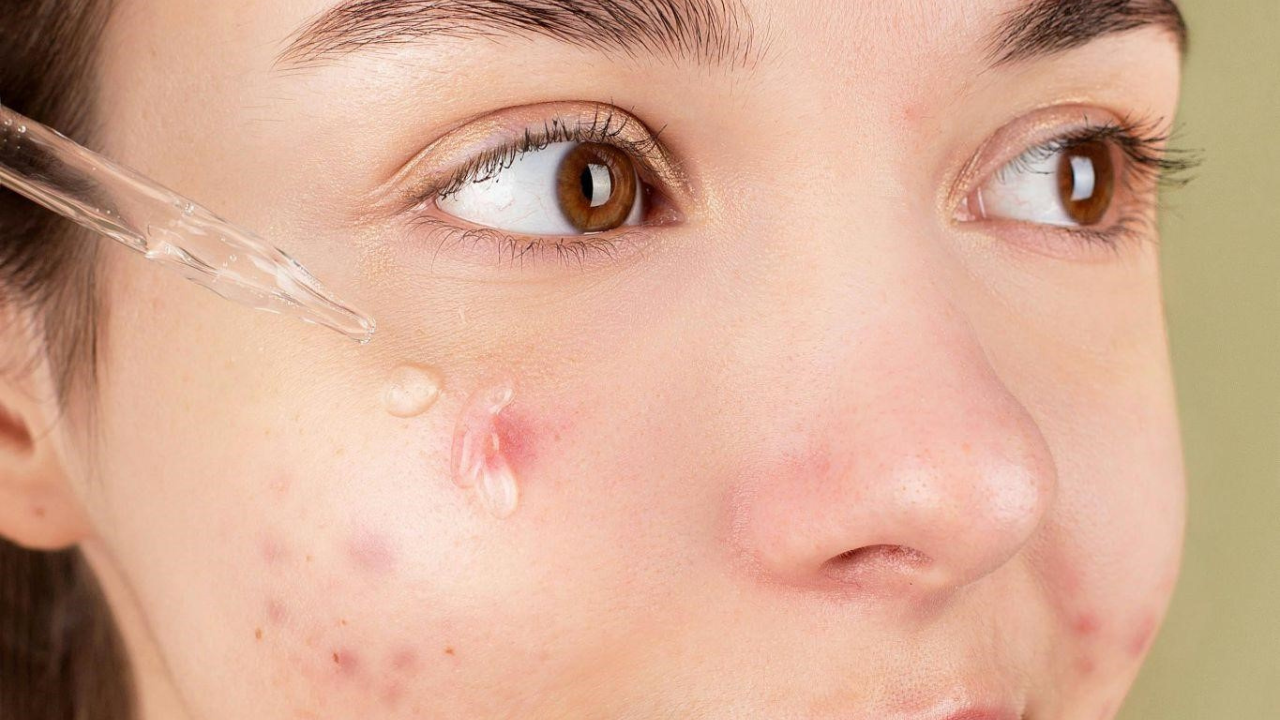 Natural Remedies for Acne: Effective Solutions from Australian Nature